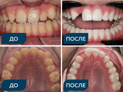 Адентия, дистальная окклюзия, скученность.