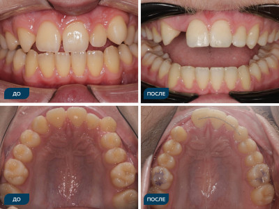Первичная адентия зуба 12, дистальная окклюзия, вестибулярное положение 13, на нижней челюсти-скученность 1 степени по Болтону.