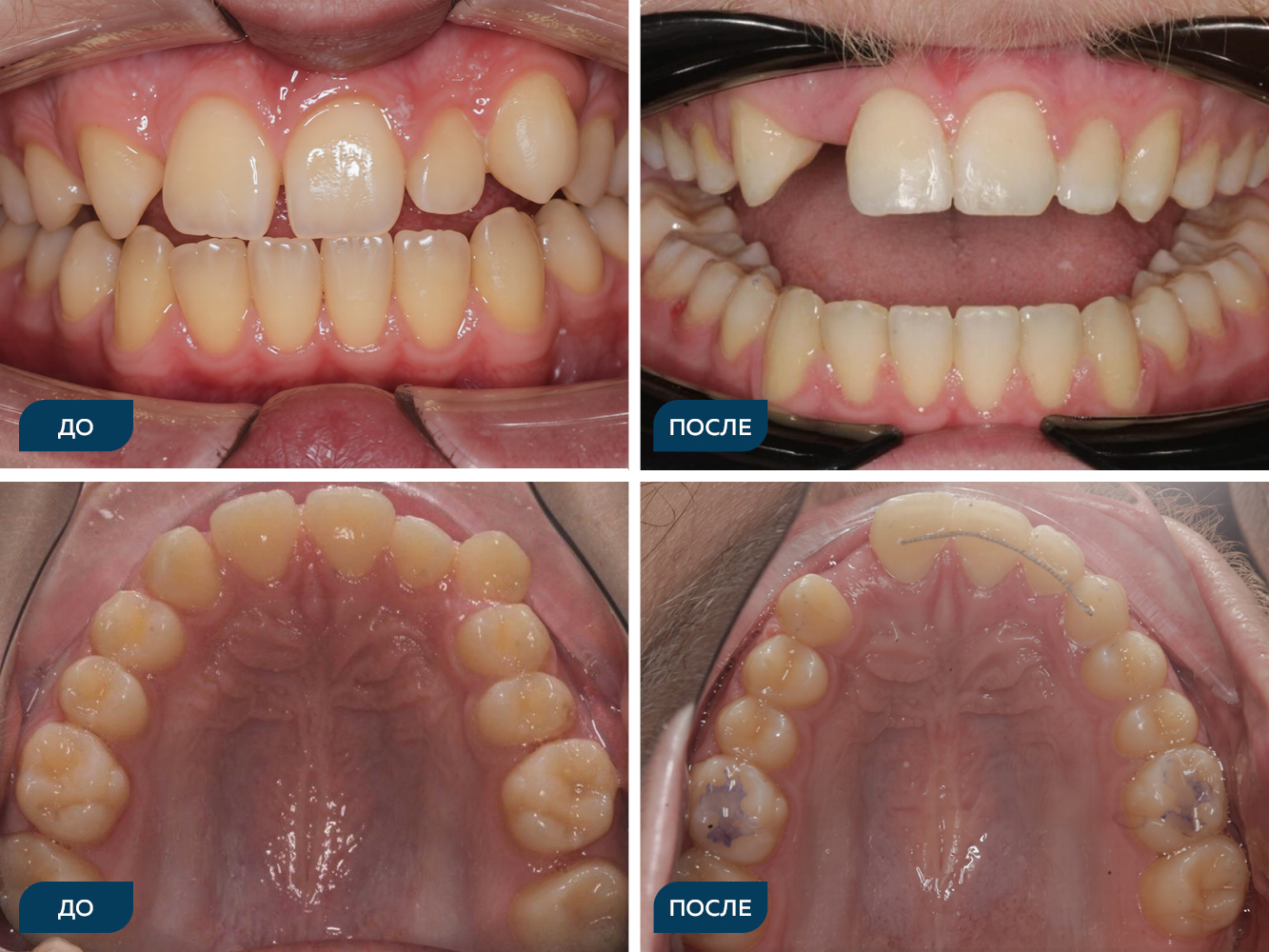 Первичная адентия зуба 12, дистальная окклюзия, вестибулярное положение 13, на нижней челюсти-скученность 1 степени по Болтону.