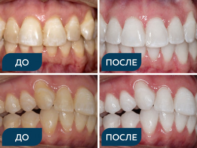 Окклюзия, скученность зубов