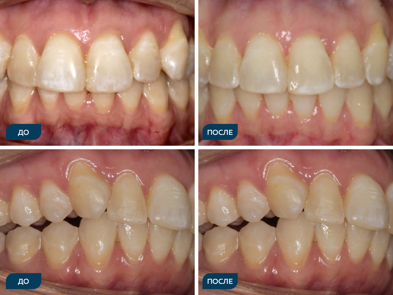 Окклюзия, скученность зубов