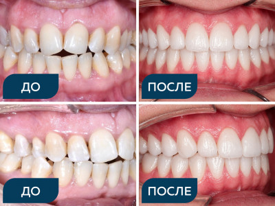 Дезокклюзия, сужение зубных рядов