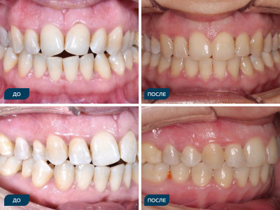 Дезокклюзия, сужение зубных рядов.