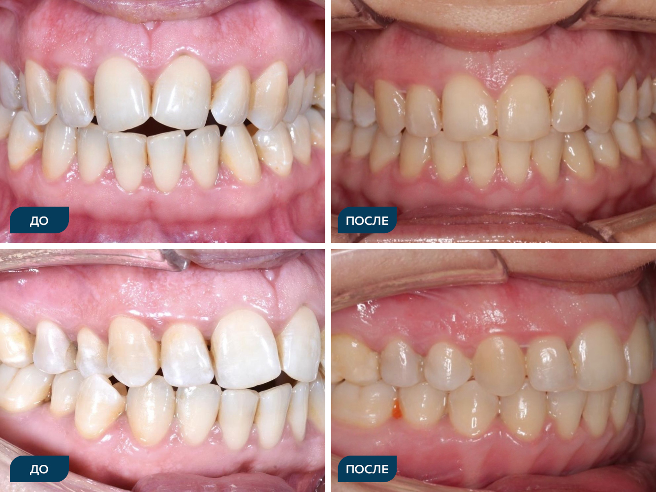 Дезокклюзия, сужение зубных рядов.