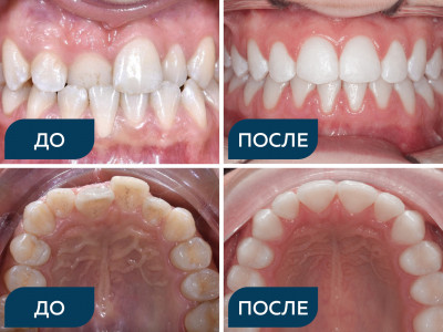 Аномалии положения зубов