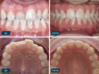 Аномалии положения зубов.