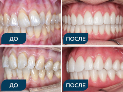 Аномалии положения зубов, суженные зубные ряды, скученность