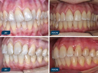 Аномалии положения зубов, суженные зубные ряды, скученность.