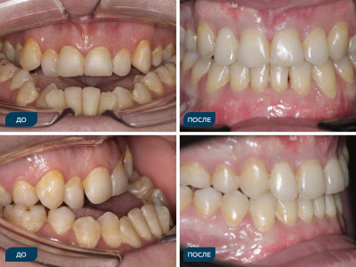 Дезокклюзия, аномалии положения зубов, скученность.