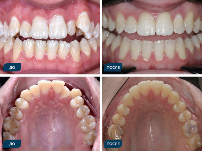 Скученность, вертикальная резцовая дезокклюзия.