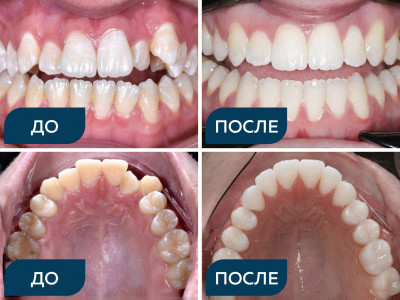 Скученность, вертикальная резцовая дезокклюзия