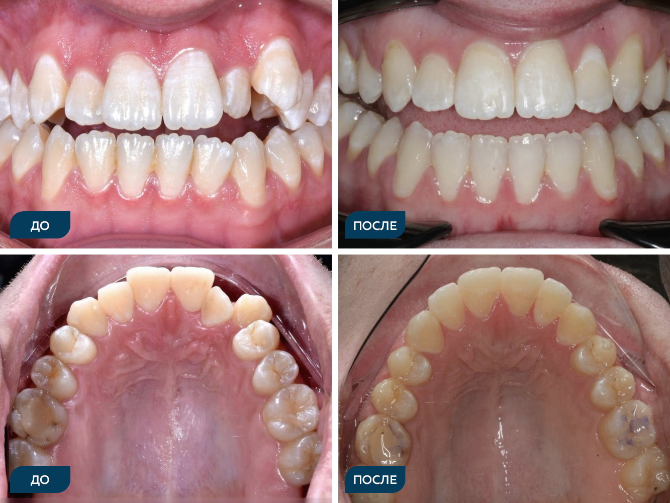 Скученность, вертикальная резцовая дезокклюзия.