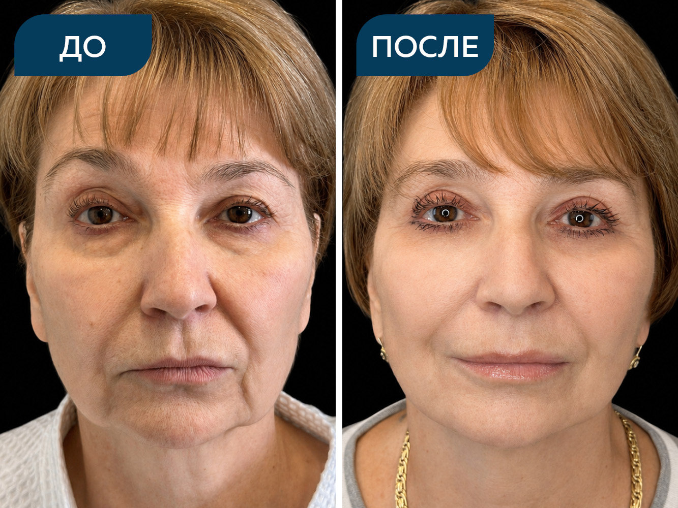 Блефаропластика, подтяжка лица