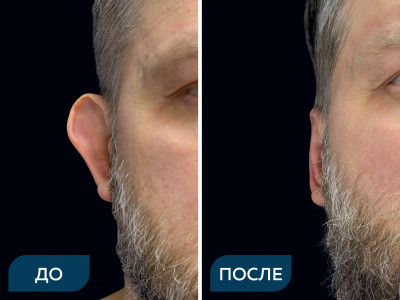 Отопластика под местной анестезией