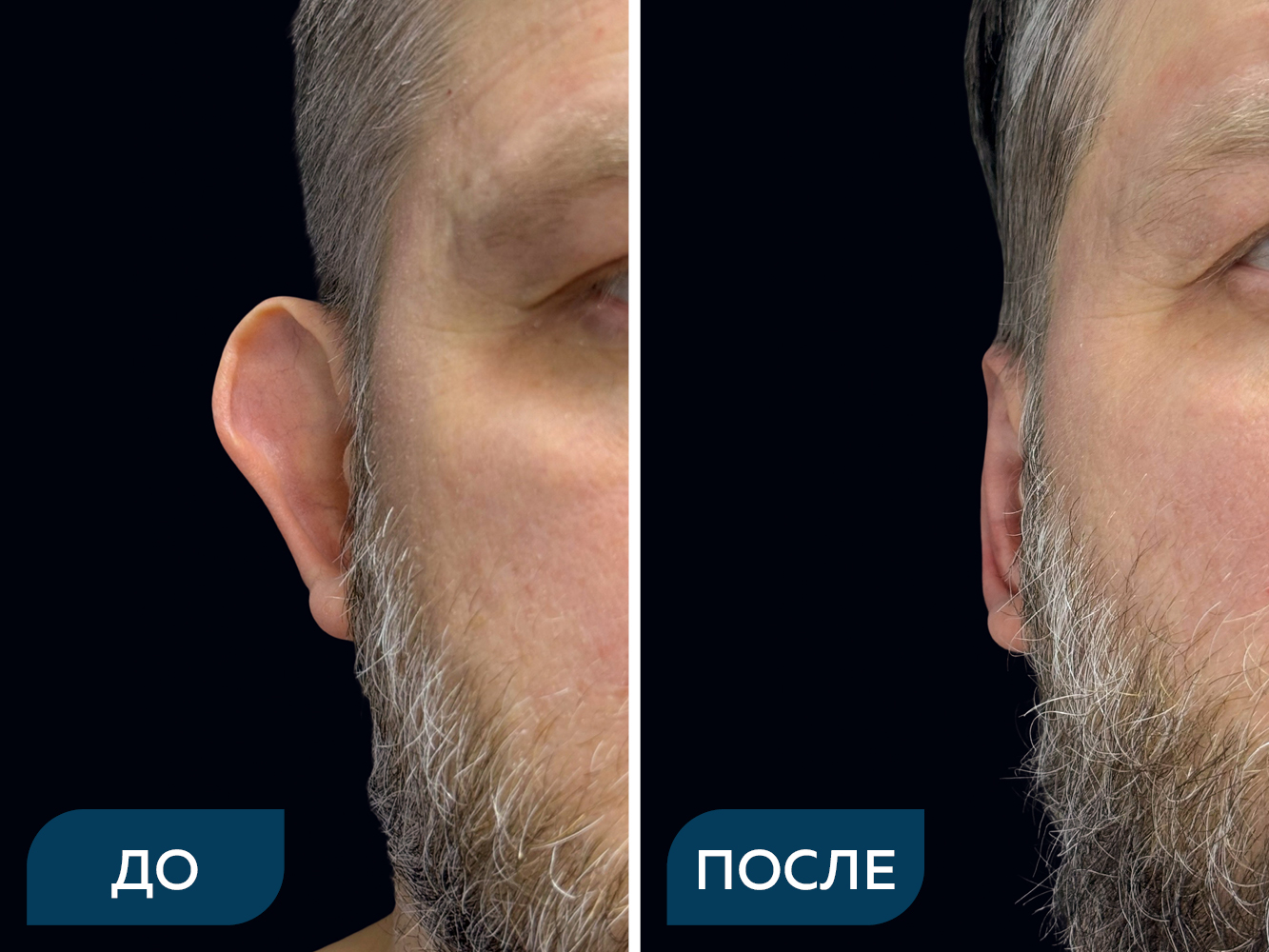 Отопластика под местной анестезией