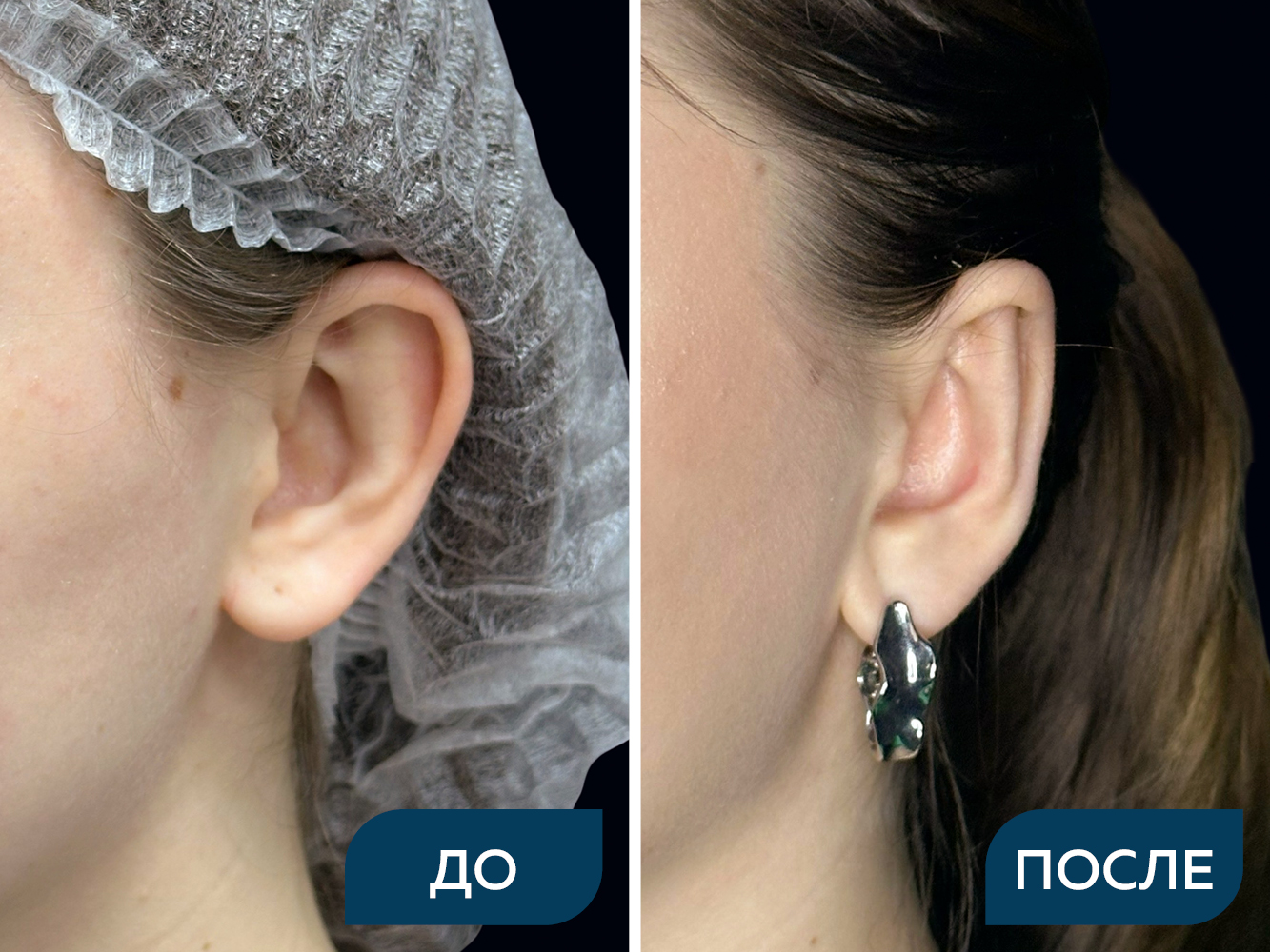Отопластика под местной анестезией. Кейс 2