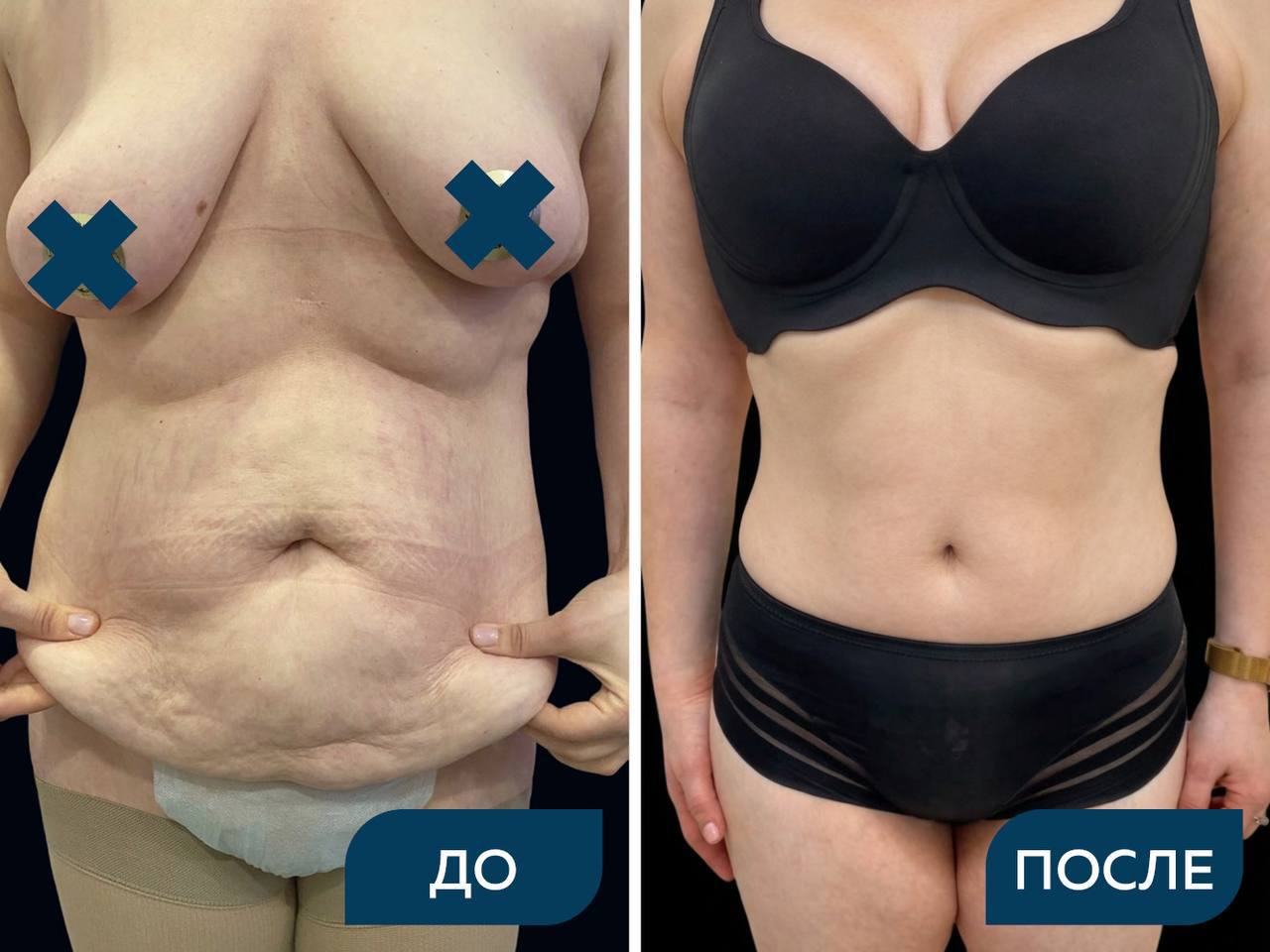 Классическая липоабдоминопластика, липосакция 360 градусов
