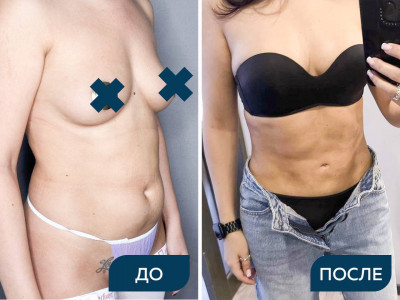 Липосаксия 360 градусов, липоскульптурирование