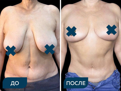 Липоабдоминопластика с ушиванием диастаза, мастопексия без имплантов