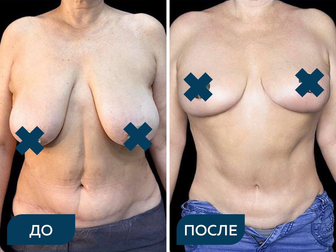 Липоабдоминопластика с ушиванием диастаза, мастопексия без имплантов