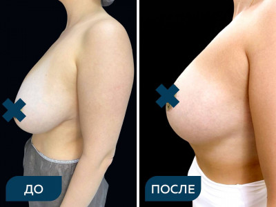 Редукционная мастопексия