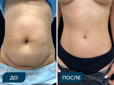 Классическая липоабдоминопластика с ушиванием диастаза прямых мышц, липосакция 360 градусов, перемещение пупка