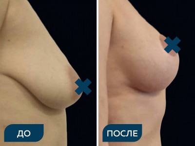 Подтяжка груди Т-образным разрезом, установка имплантов