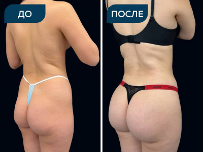 Липоскульптура (липосакция + липофилинг ягодиц)