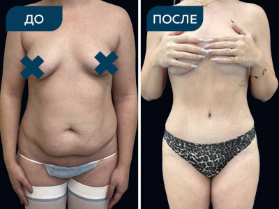 Абдоминопластика с липосакцией живота, спины