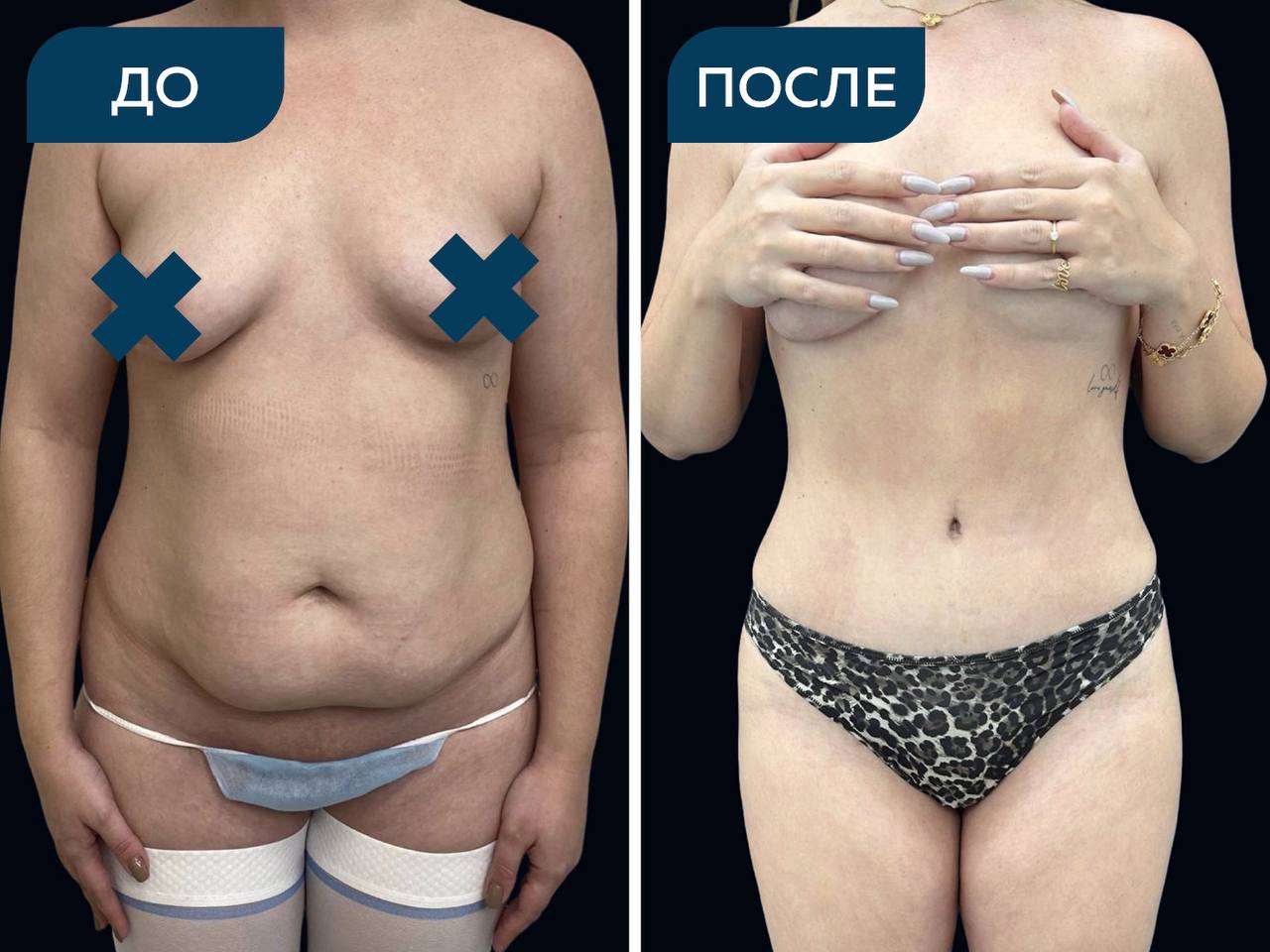 Абдоминопластика с липосакцией живота, спины