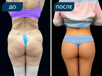 Бодилифт и липофилинг ягодиц