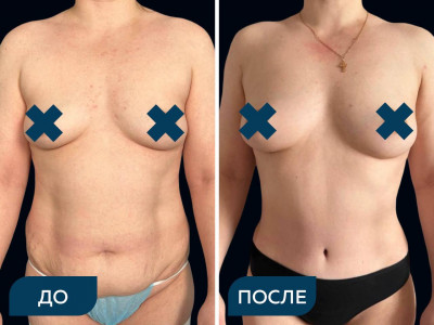 Абдоминопластика, липосакция живота, липосакция спины