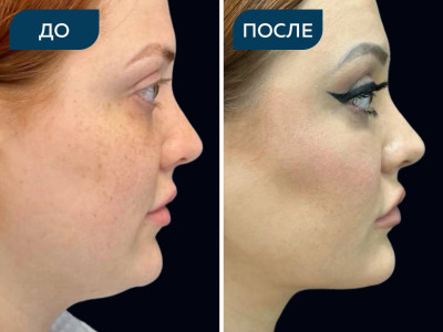 Липосакция шеи, подбородка