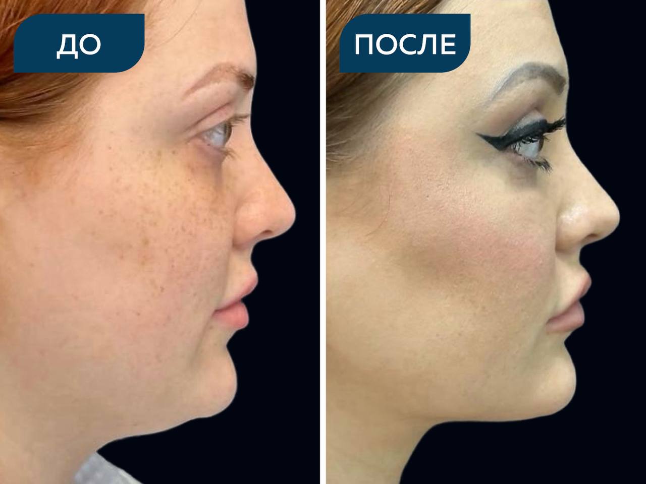 Липосакция шеи, подбородка