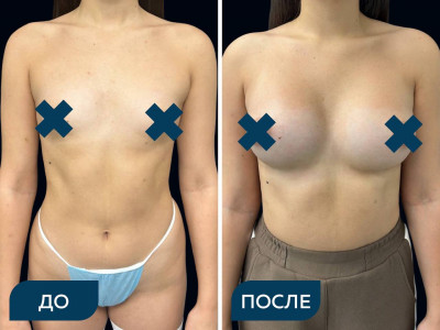 Увеличение груди анатомическими имплантами