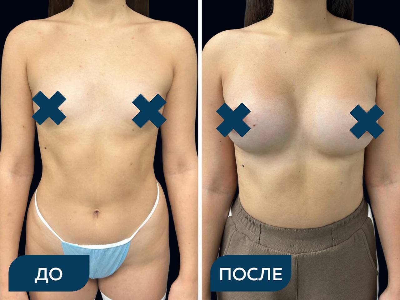 Увеличение груди анатомическими имплантами