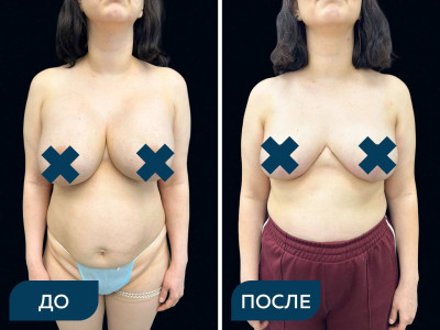 Удаление имплантов с повторной подтяжкой молочных желез и липосакцией подмышек