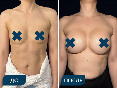 Увеличение груди с помощью имплантов