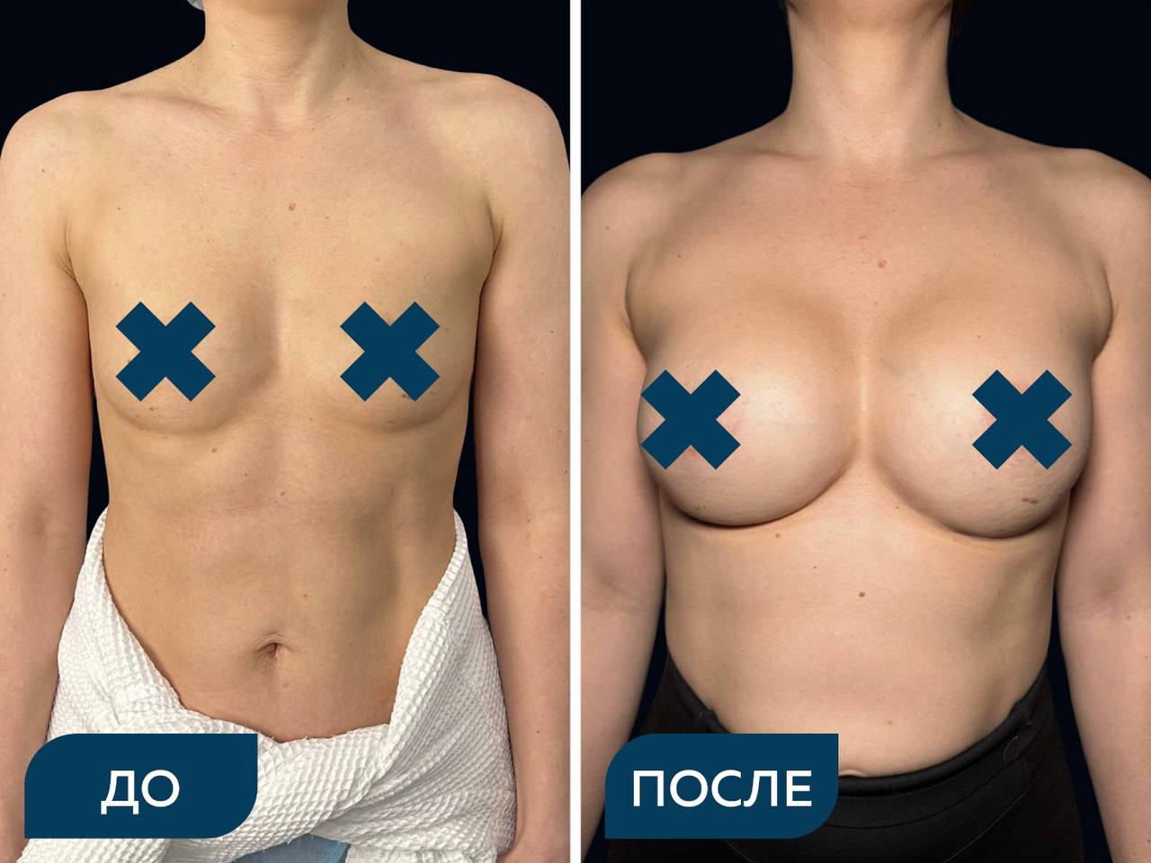 Увеличение груди с помощью имплантов