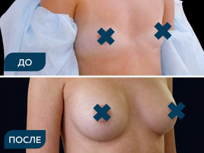 Увеличение молочных желез имплантами