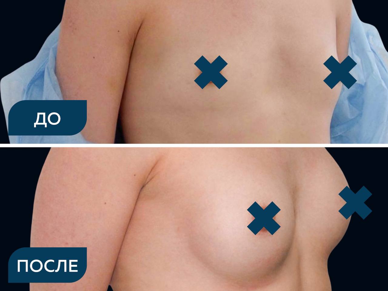 Эндопротезирование (увеличение) молочных желез сферическими имплантами