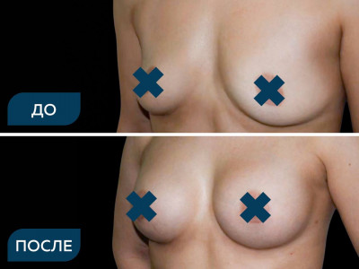 Увеличение (эндопротезирование) молочных желез сферическими имплантами.