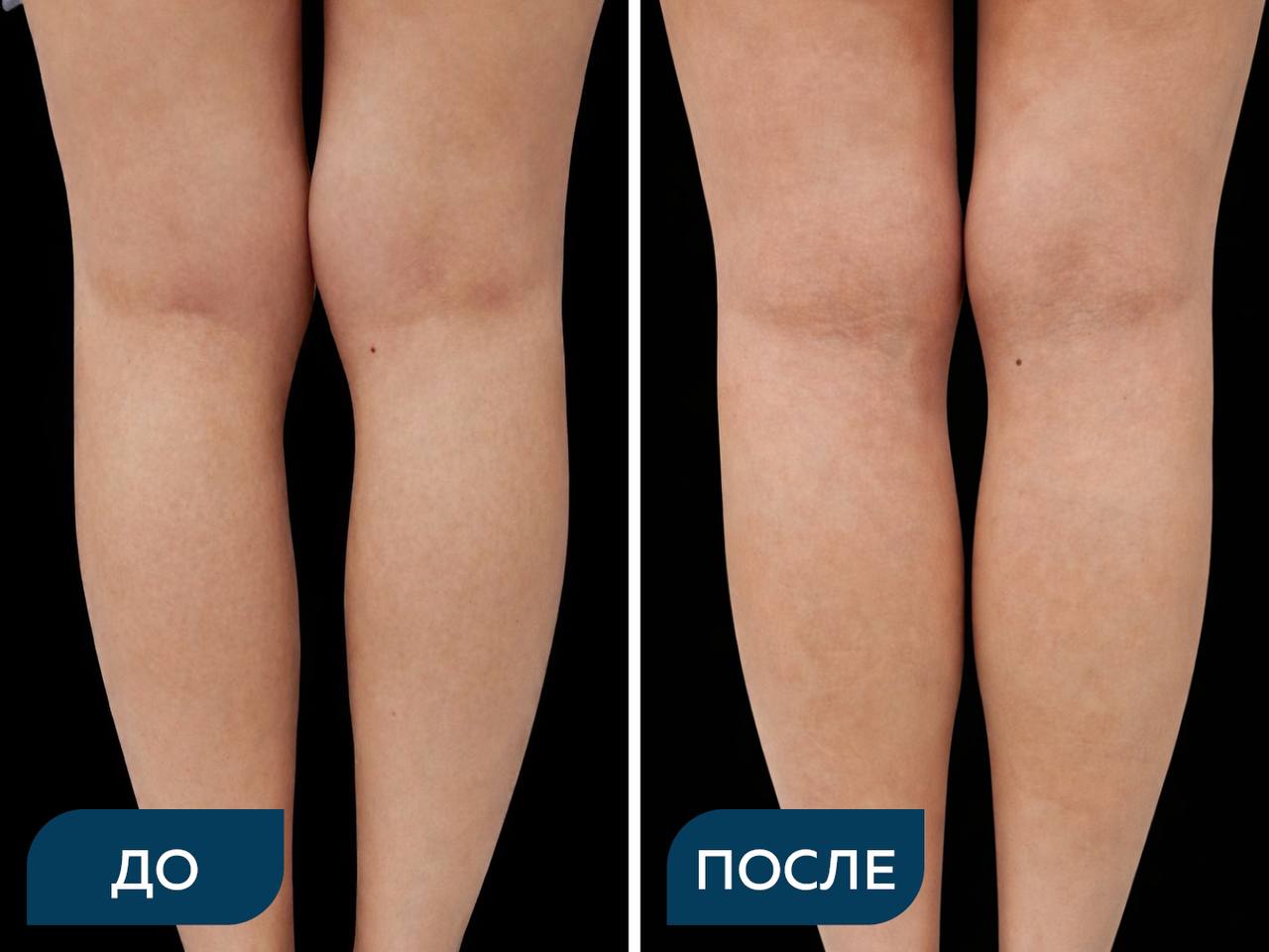 Эндопротезирование голеней