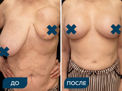Удаление экспандера, установка импланта, уменьшение груди