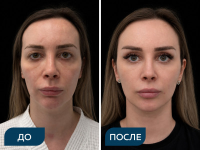 Блефаропластика круговая, липофилинг лица, липосакция шеи