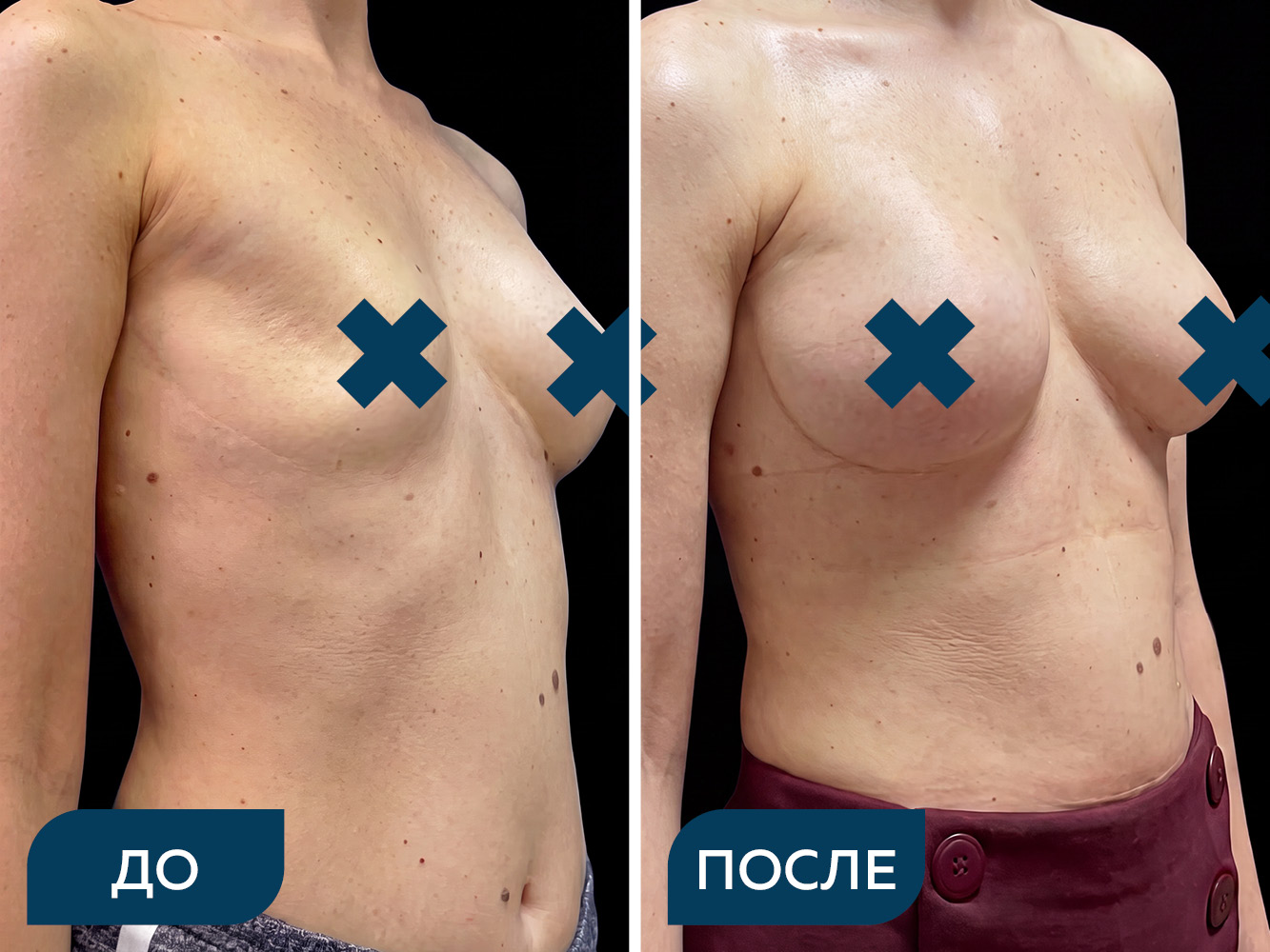 Реконструкция молочной железы, установка импланта под мышцу