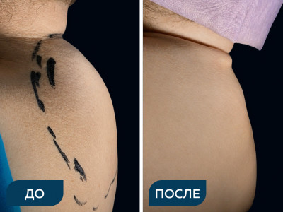 Коррекция вдобьего горба
