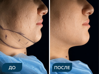 Липосакция подбородка под местной анестезией
