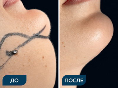 Липосакция подбородочной области под местной анестезией