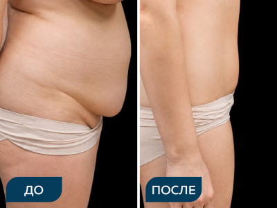 Липосакция передней брюшной стенки с липосакцией